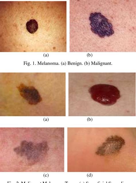 stage 4 metastatic melanoma cancer